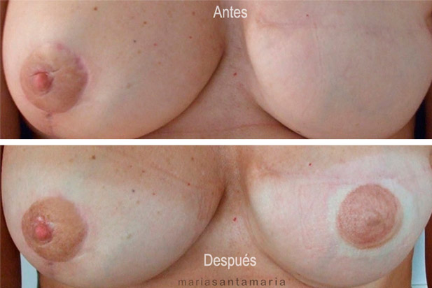 Reconstrucción de areola