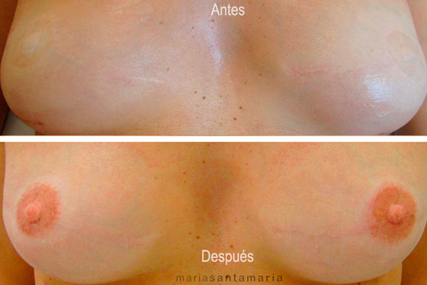 Areolas