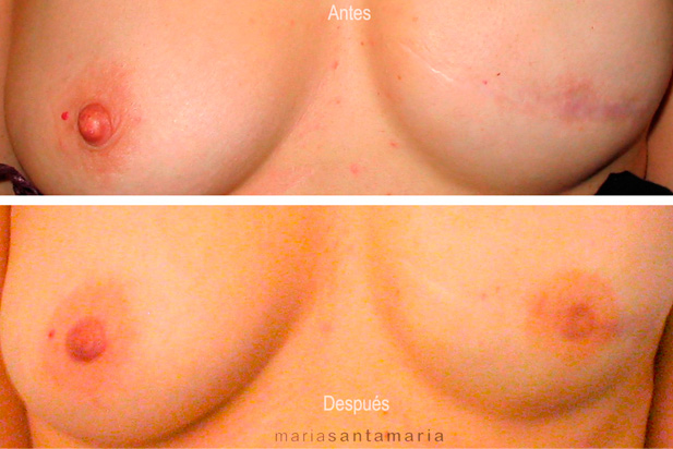 Reconstrucción de areola