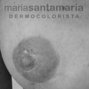 Reconstrucción de areola