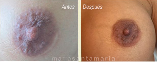 Cicatriz en areola